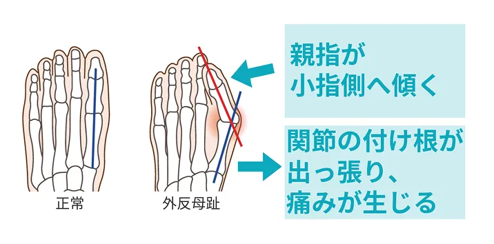 外反母趾の図解