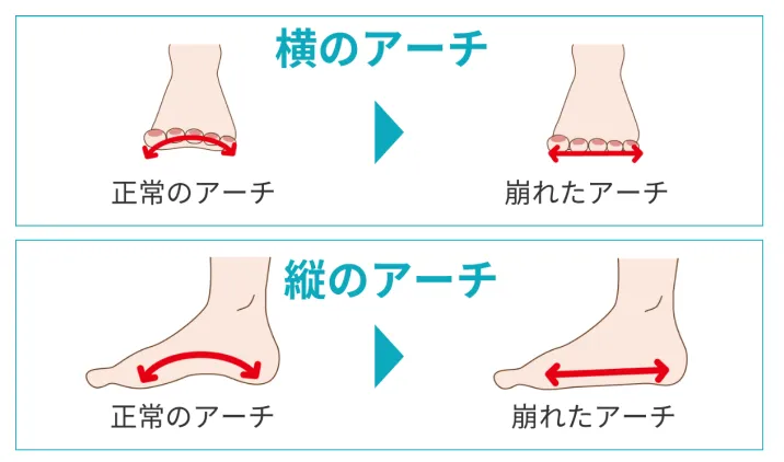 外反母趾の図解