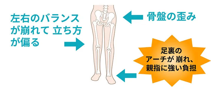外反母趾の図解