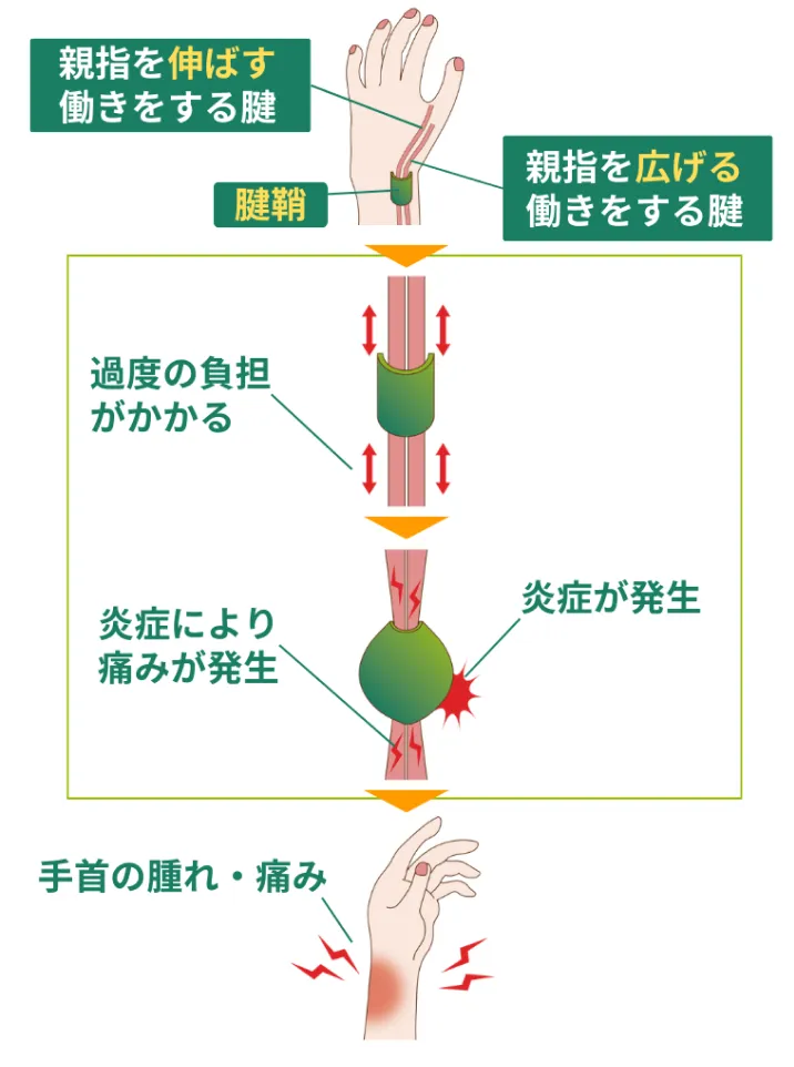 腱鞘炎とは？図解