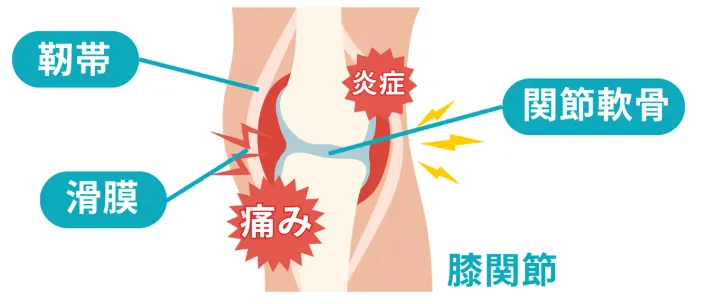 膝痛の図解