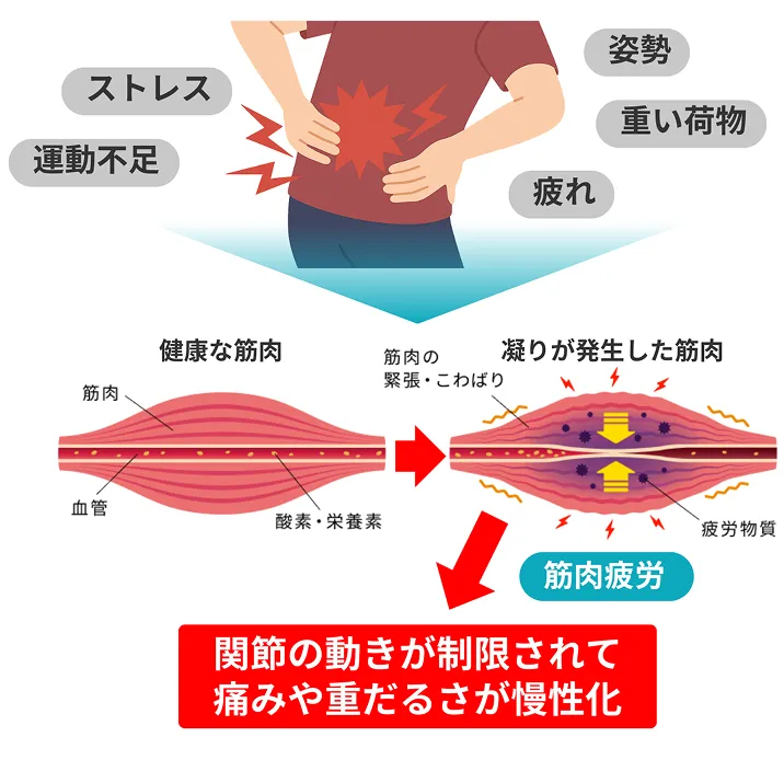 腰痛の図解