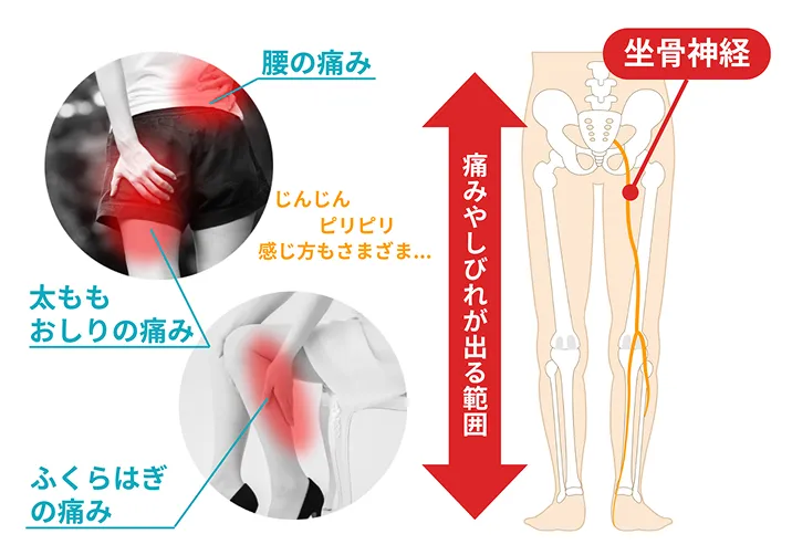坐骨神経痛の図解