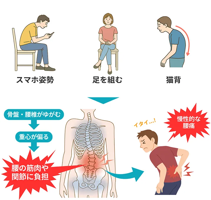 坐骨神経痛の図解