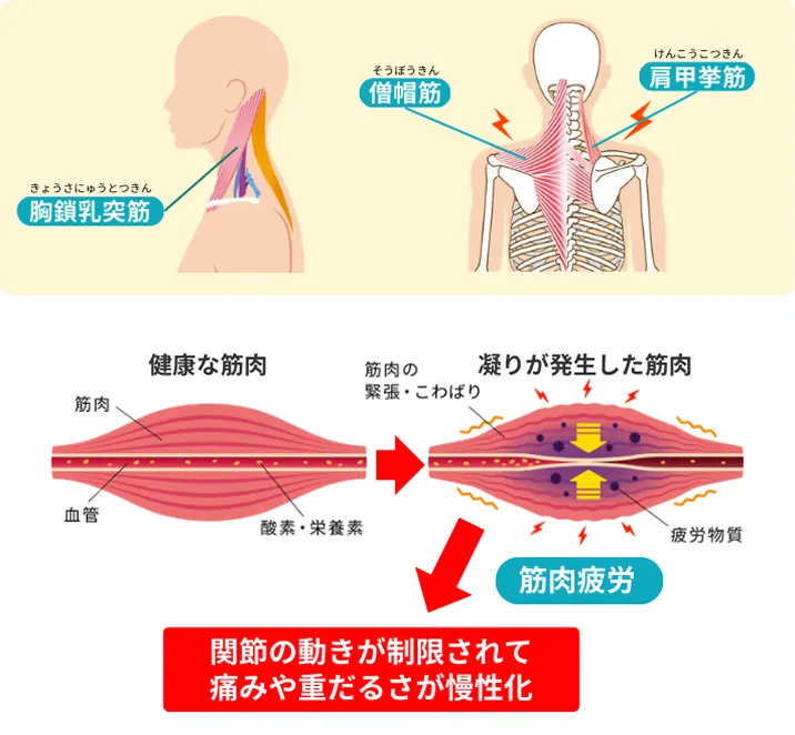 肩こりの図解