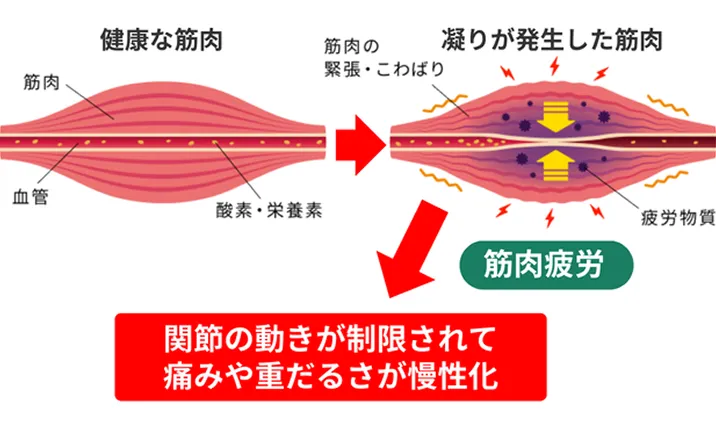 腱鞘炎の根本原因03